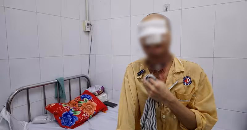 Tái tạo khuôn mặt cho bệnh nhân bị bỏng bằng da bụng và sụn sườn